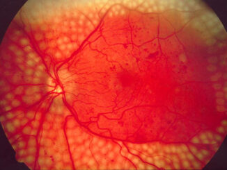 Retinopatia-diabetica-cop