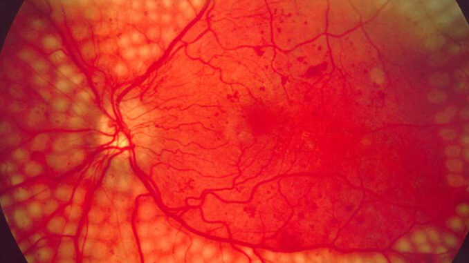 Retinopatia-diabetica-cop