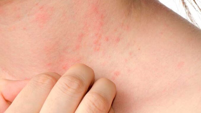 visuels-article6_SS&M4_allergic-cop