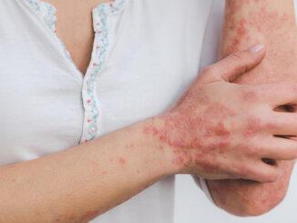 artrite-psoriasica-cop