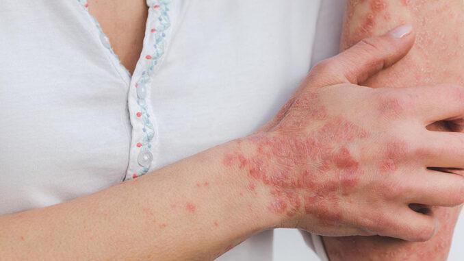 artrite-psoriasica-cop